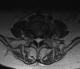 MR_MRI LUMBAR SPINE WITHOUT CONTRAST_AXIAL T2 MSMA_2023-08-16.png
